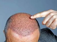 Saç Ektiren Hastalar İçin Altın Kurallar