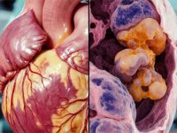 Doç. Dr. Sert, “Ülkemizde her yıl 41 bin kişiye akciğer kanseri teşhisi konuyor”